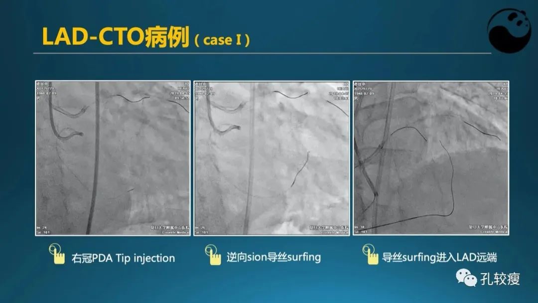 CTO病变主动迎客技术之我见
