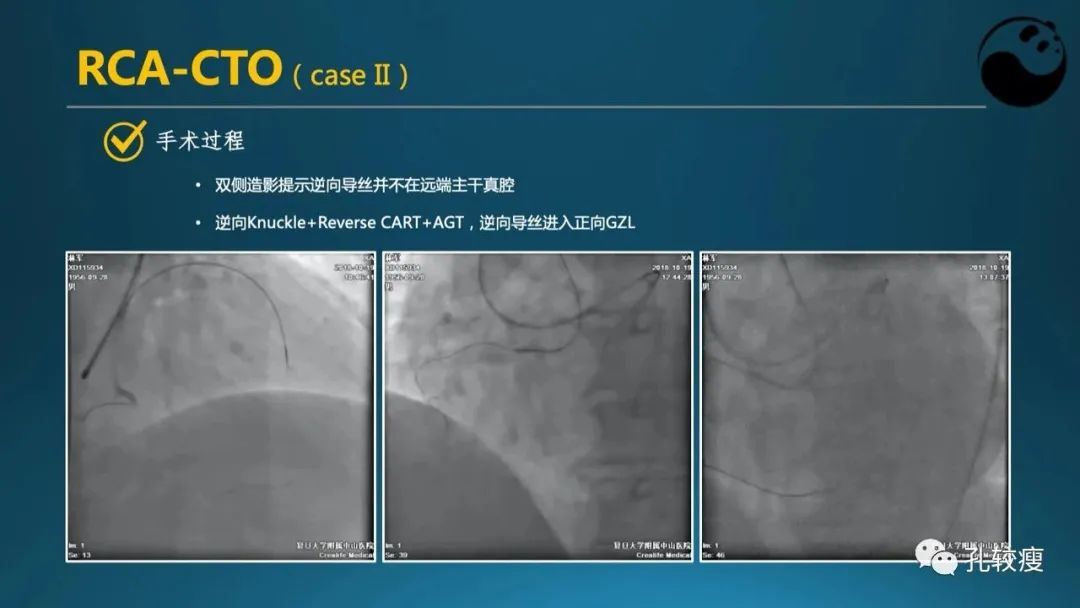 CTO病变主动迎客技术之我见