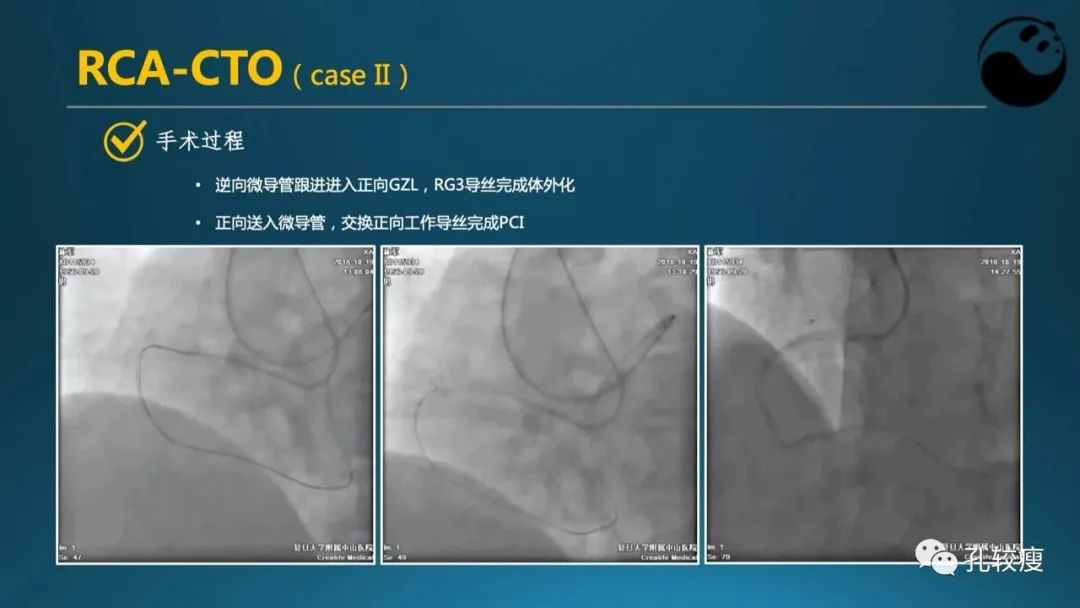 CTO病变主动迎客技术之我见