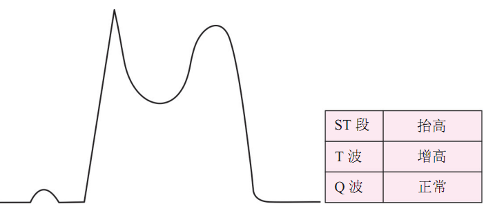 急性心肌梗死（STEMI）心电图（ECG）演变
