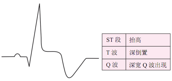 急性心肌梗死（STEMI）心电图（ECG）演变