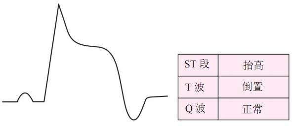 急性心肌梗死（STEMI）心电图（ECG）演变