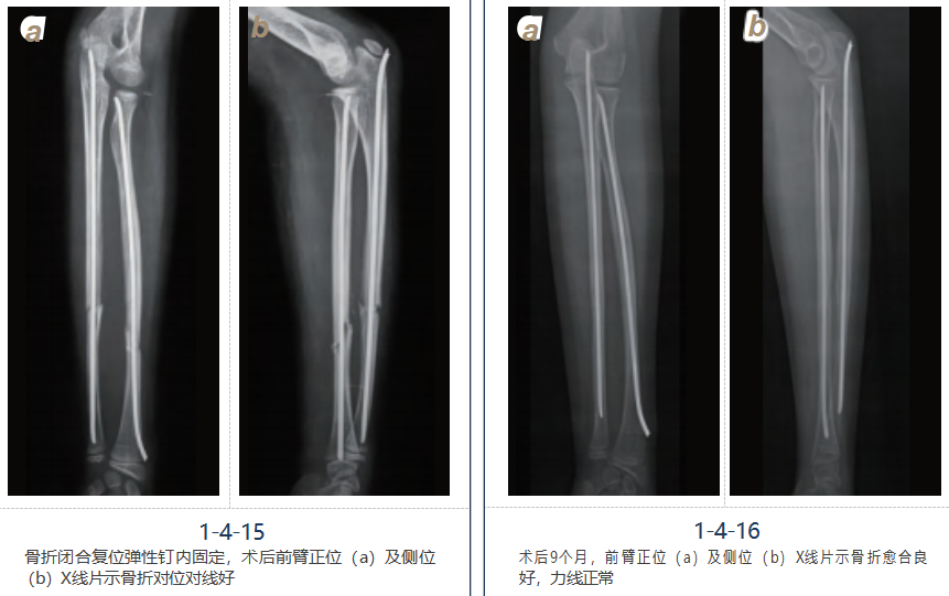 儿童尺桡骨干骨折弹性髓内钉技术(看完这篇就够了)
