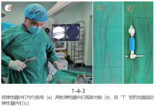 儿童尺桡骨干骨折弹性髓内钉技术(看完这篇就够了)