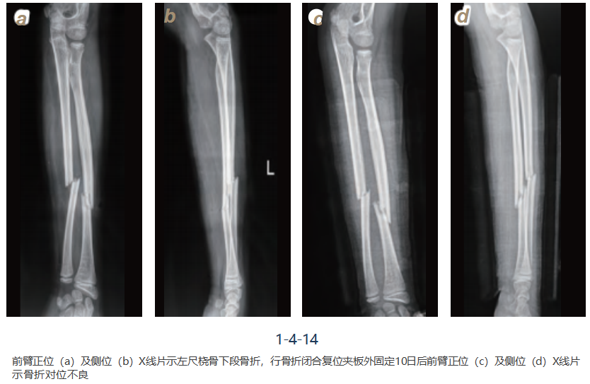 儿童尺桡骨干骨折弹性髓内钉技术(看完这篇就够了)