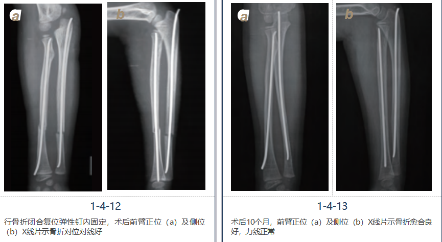 儿童尺桡骨干骨折弹性髓内钉技术(看完这篇就够了)
