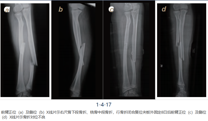 儿童尺桡骨干骨折弹性髓内钉技术(看完这篇就够了)