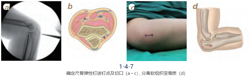 儿童尺桡骨干骨折弹性髓内钉技术(看完这篇就够了)
