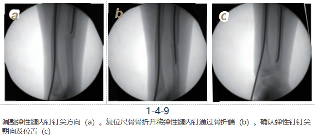 儿童尺桡骨干骨折弹性髓内钉技术(看完这篇就够了)