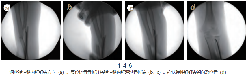 儿童尺桡骨干骨折弹性髓内钉技术(看完这篇就够了)