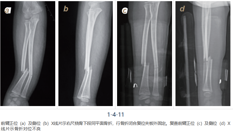 儿童尺桡骨干骨折弹性髓内钉技术(看完这篇就够了)