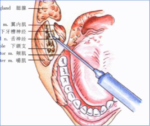 麻醉术：口腔局部麻醉
