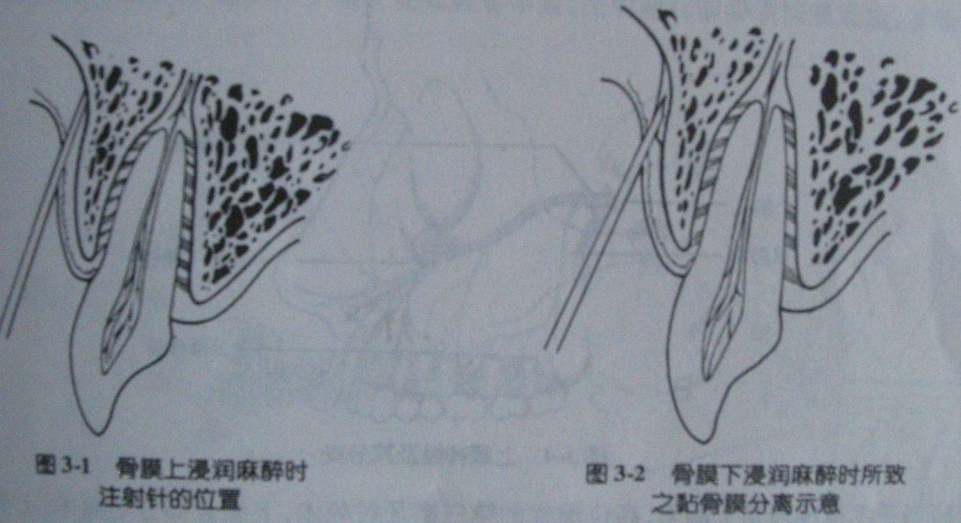麻醉术：口腔局部麻醉
