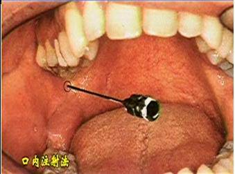 麻醉术：口腔局部麻醉