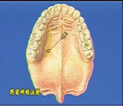 麻醉术：口腔局部麻醉