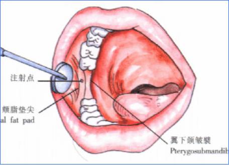 麻醉术：口腔局部麻醉