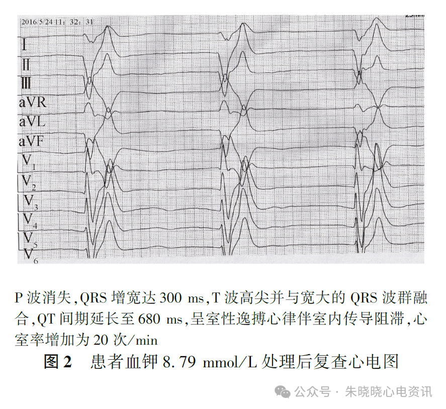 高钾血症:如何一步步 “改写” 窦室传导动态轨迹 - 好医术文章 - 好医术-赋能医生守护生命