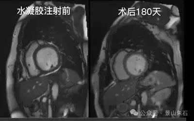 学习笔记：心衰介入治疗