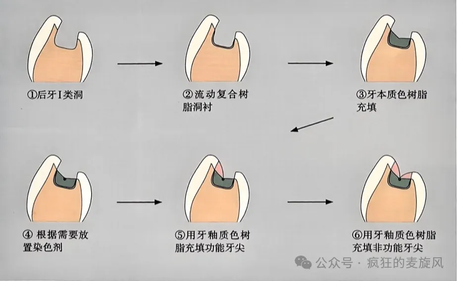 树脂修复活髓牙术后出现敏感可咋整?