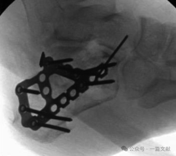 跟骨骨折内固定术中透视技巧