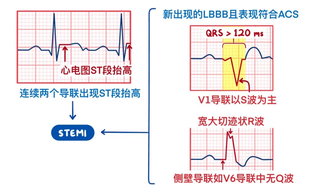 急性冠状动脉综合征,临床必备!