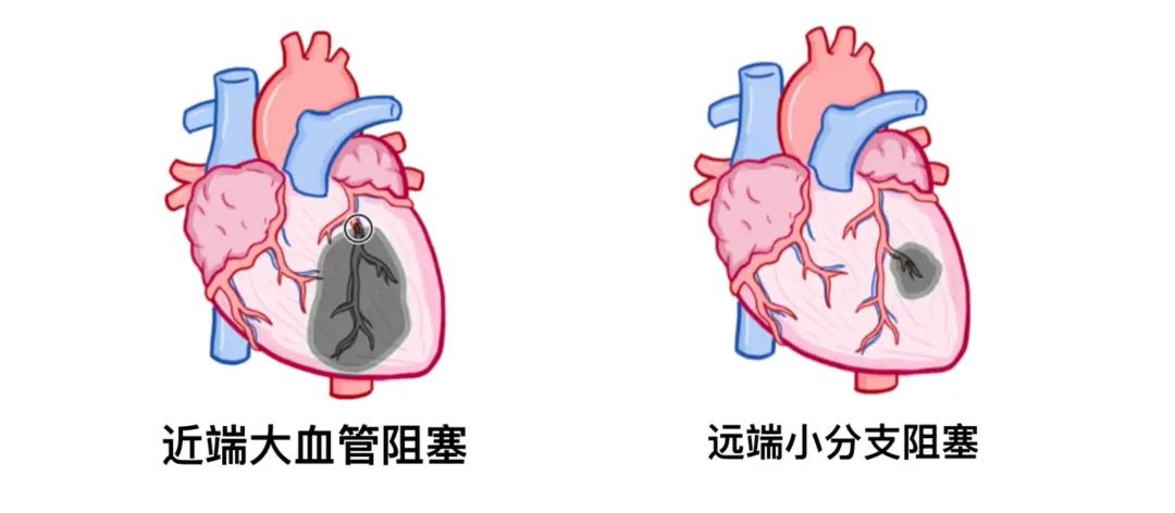 急性冠状动脉综合征,临床必备!