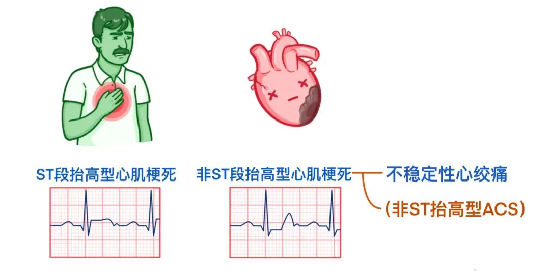 急性冠状动脉综合征,临床必备!