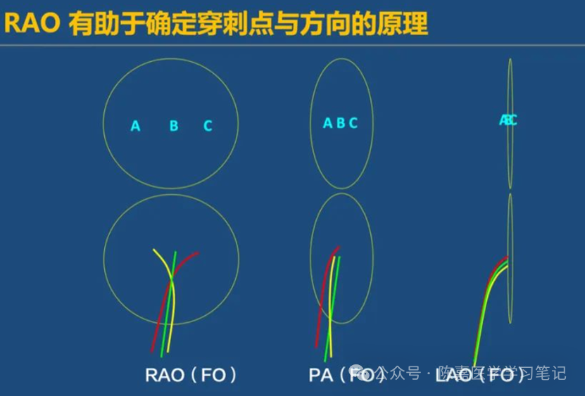 房间隔穿刺，是什么？为什么？怎么做？怎样做更好？