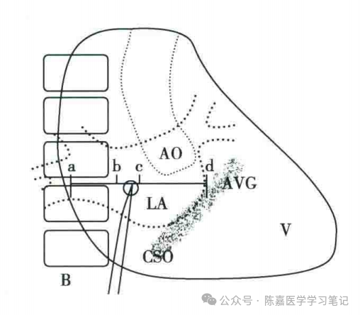 房间隔穿刺，是什么？为什么？怎么做？怎样做更好？