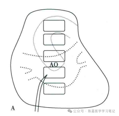 房间隔穿刺，是什么？为什么？怎么做？怎样做更好？