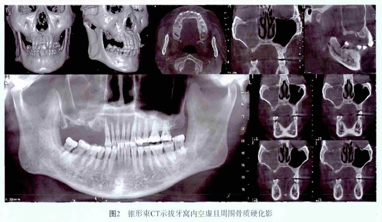 忽视这个“冷门”拔牙禁忌症，风险不容小视！