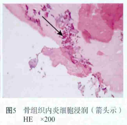 忽视这个“冷门”拔牙禁忌症，风险不容小视！
