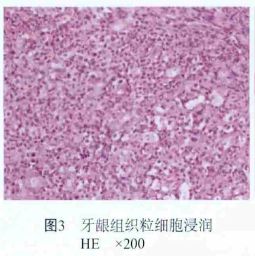 忽视这个“冷门”拔牙禁忌症，风险不容小视！