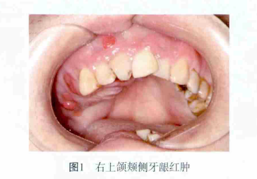 忽视这个“冷门”拔牙禁忌症，风险不容小视！
