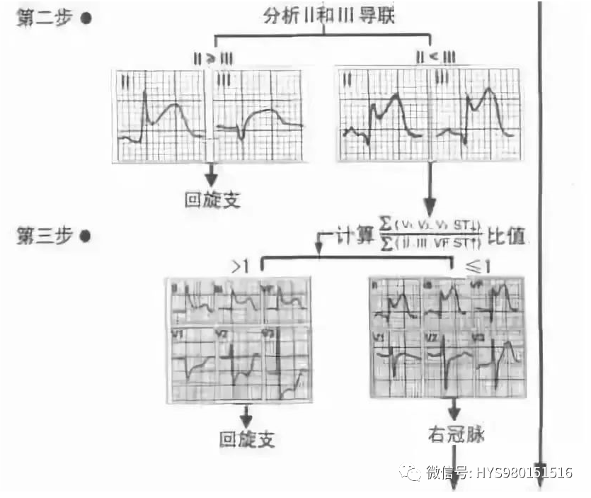 接诊心梗患者，手把手教你如何快速判断梗死部位和范围