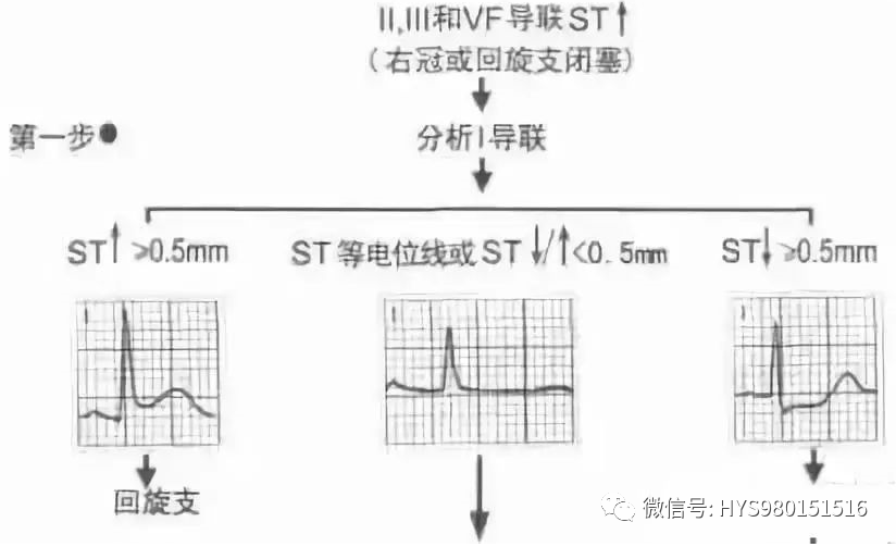 接诊心梗患者，手把手教你如何快速判断梗死部位和范围