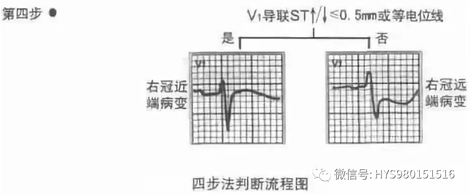 接诊心梗患者，手把手教你如何快速判断梗死部位和范围