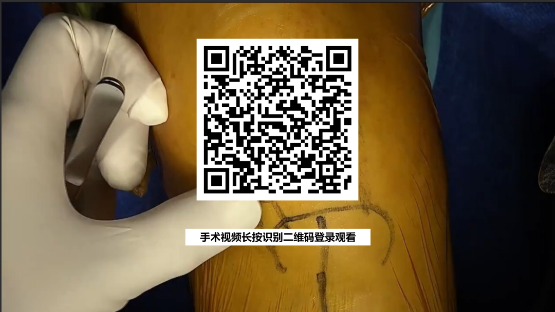 手术视频