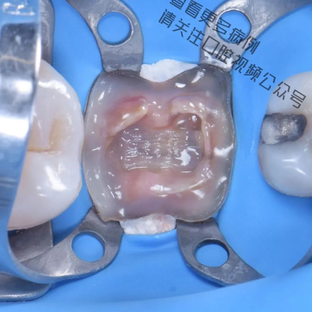 一颗濒临拔除的患牙,仿生学来修复它