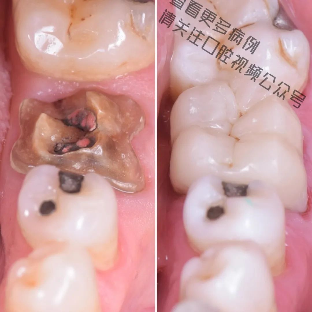 一颗濒临拔除的患牙,仿生学来修复它