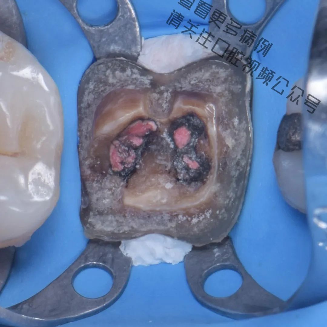 一颗濒临拔除的患牙,仿生学来修复它