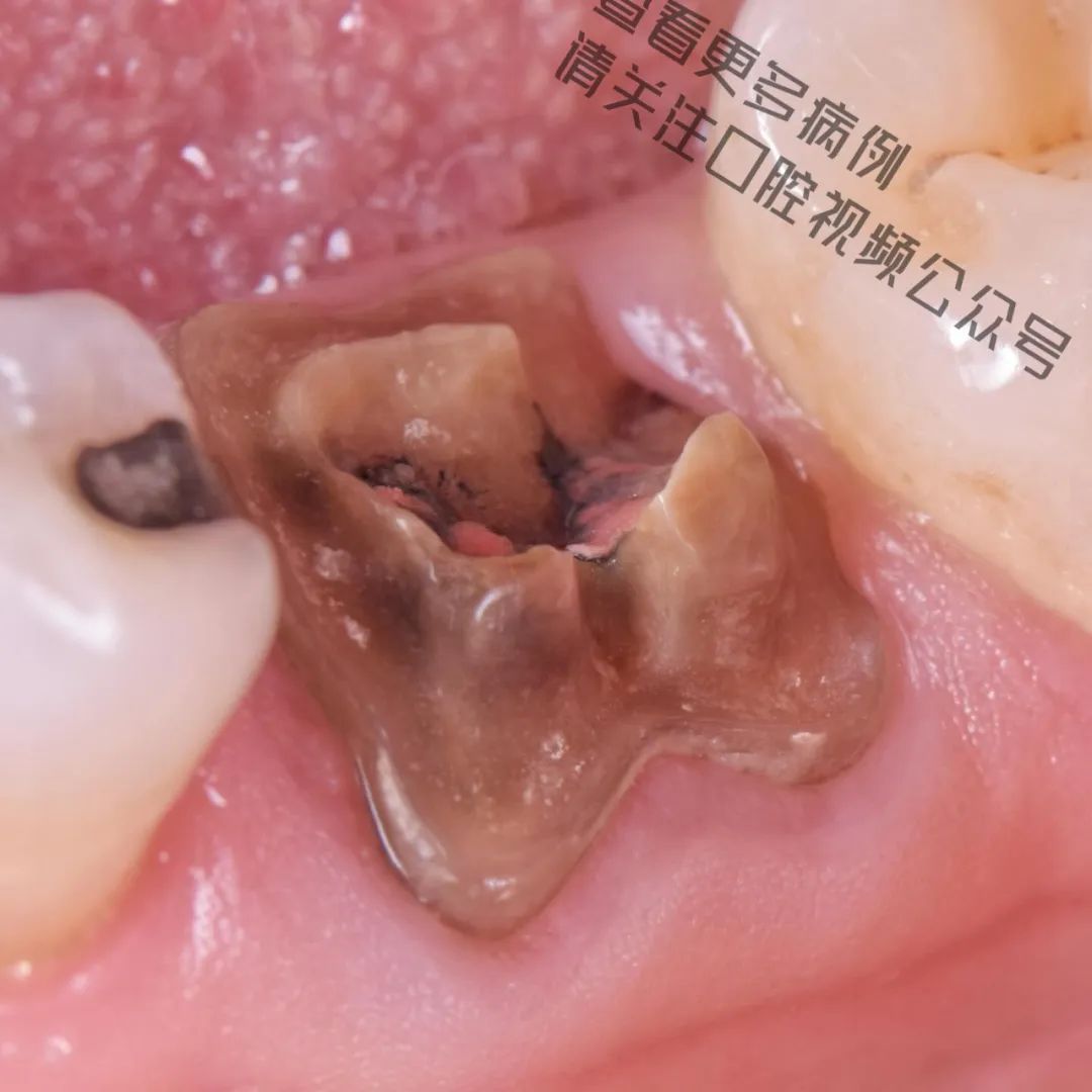 一颗濒临拔除的患牙,仿生学来修复它