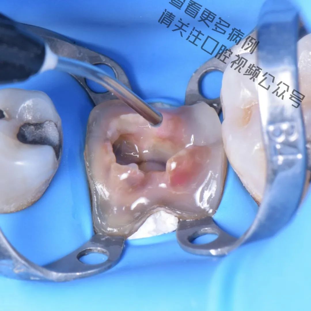 一颗濒临拔除的患牙,仿生学来修复它