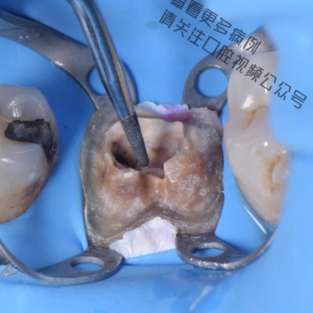 一颗濒临拔除的患牙,仿生学来修复它