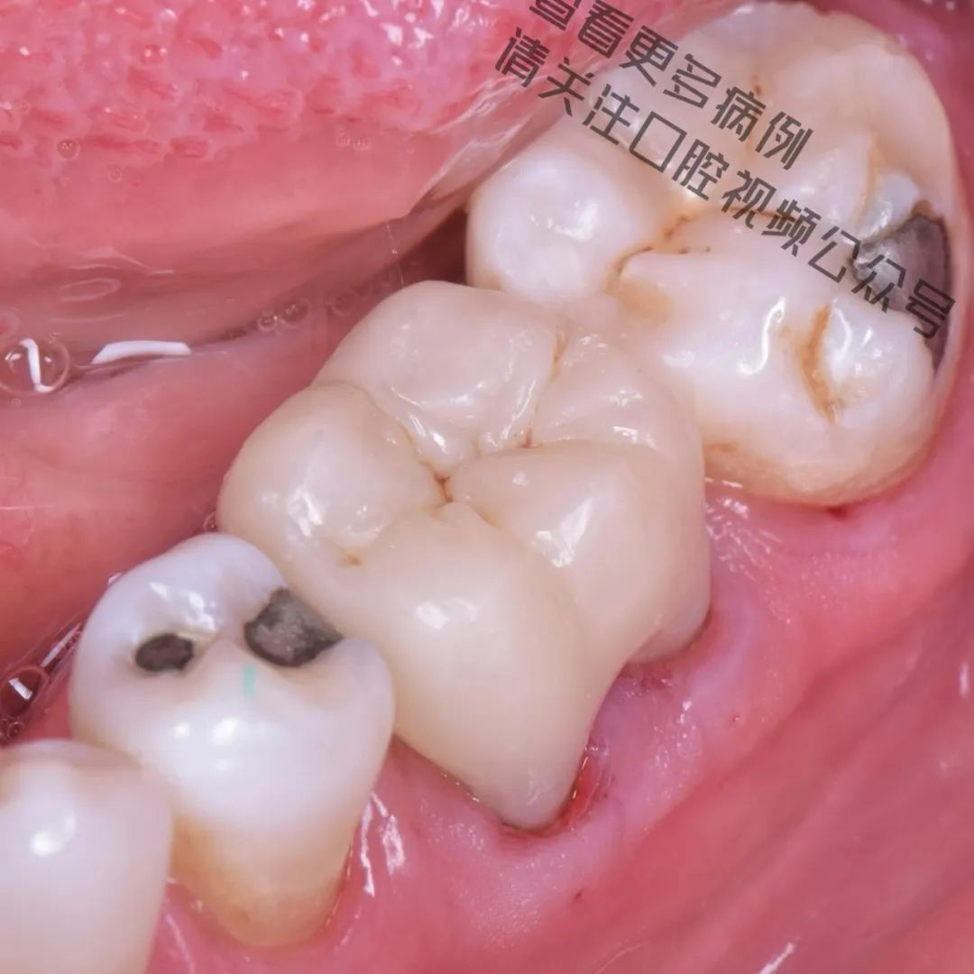 一颗濒临拔除的患牙,仿生学来修复它