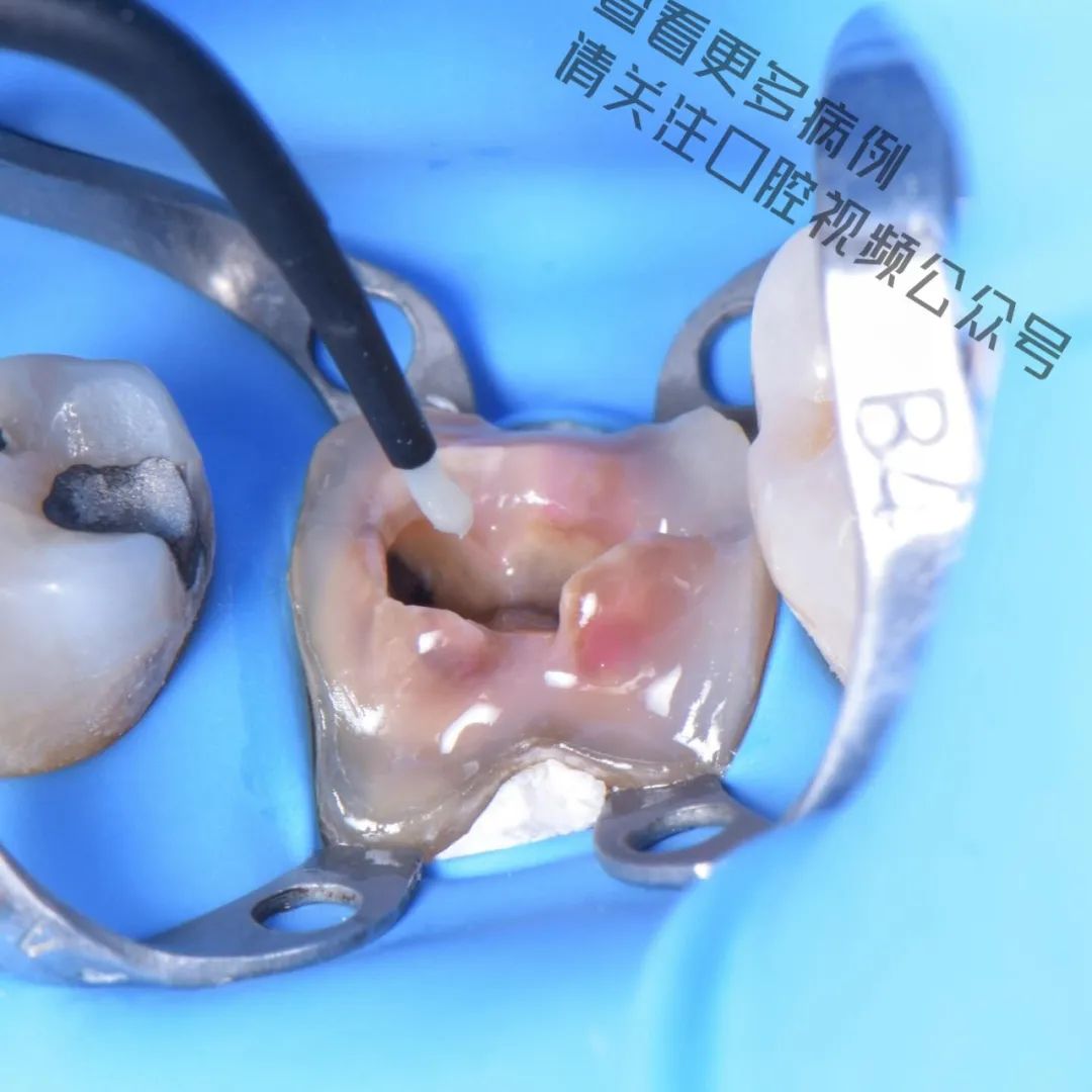 一颗濒临拔除的患牙,仿生学来修复它