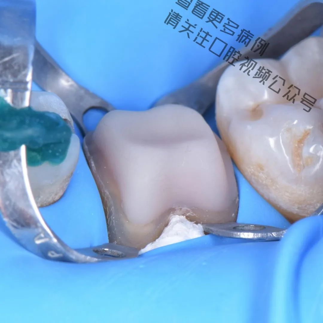 一颗濒临拔除的患牙,仿生学来修复它