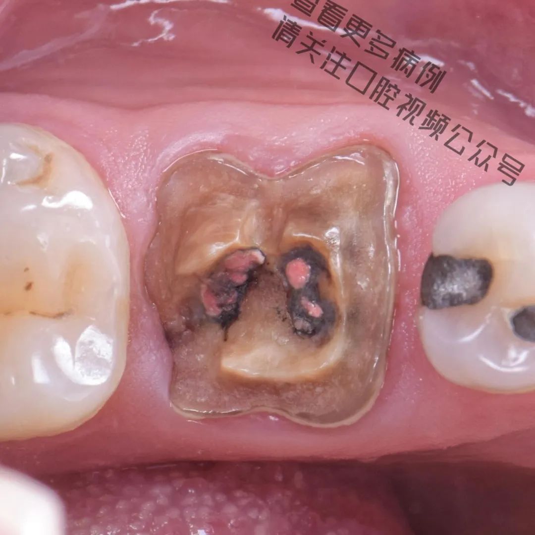 一颗濒临拔除的患牙,仿生学来修复它