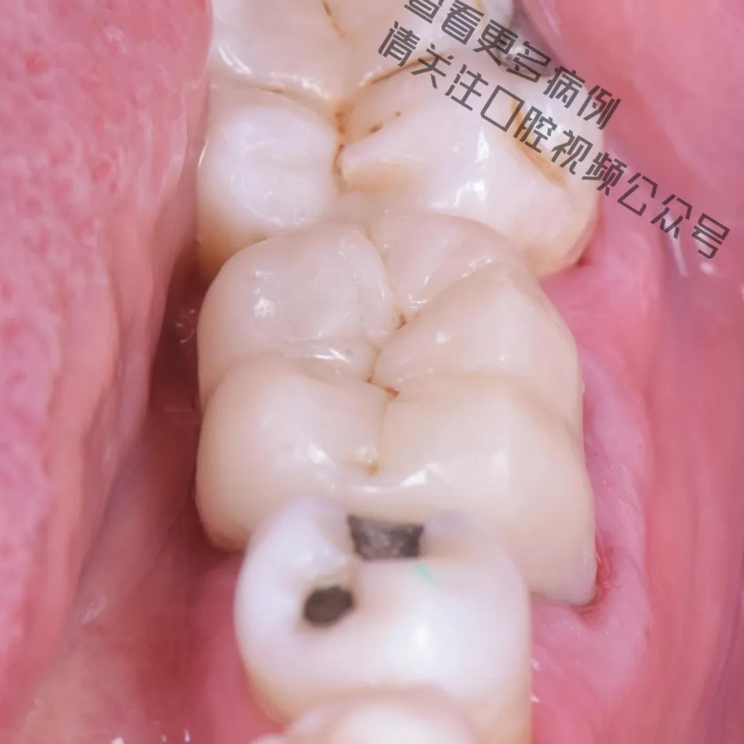 一颗濒临拔除的患牙,仿生学来修复它