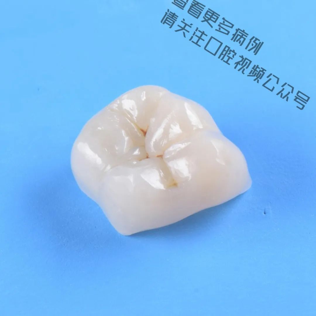 一颗濒临拔除的患牙,仿生学来修复它